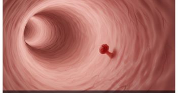 Colon Polyps Symptoms Early: What Most People Miss